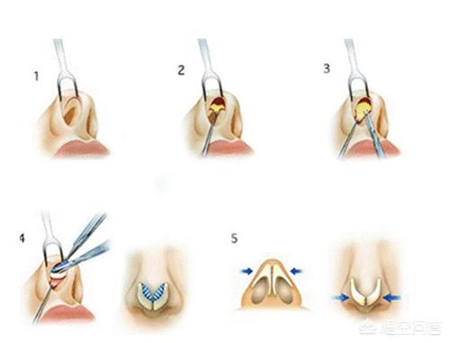 隆鼻手术怎么做,隆鼻手术怎么麻醉