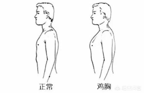 鸡胸怎么办(鸡胸怎么办最有效的方法)