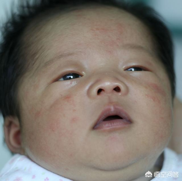 治疗湿疹最快的方法儿童六岁:小孩湿疹怎么治最快最有效四岁 宝宝湿疹了，妈妈该怎么做宝宝才能好得快？