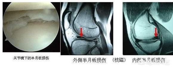 半月板损伤症状:半月板损伤症状与滑膜炎有啥区别 如何自测是不是半月板损伤？