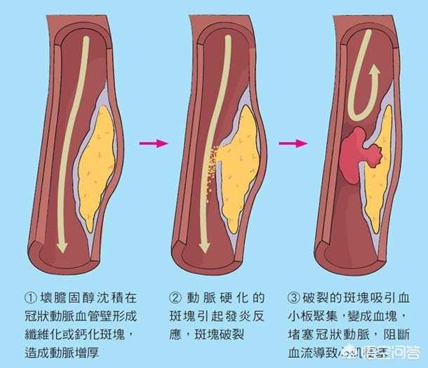 冠心病的拼音，冠心病和心绞痛的区别是什么？