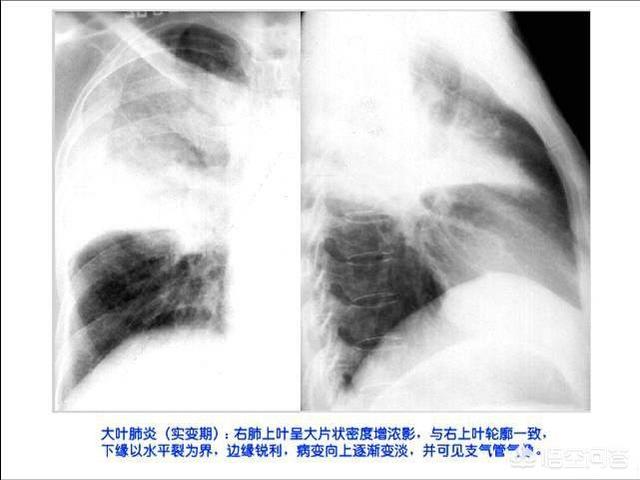 肺部曲霉菌感染症状:肺部曲霉菌感染没有任何症状需要治疗吗 怎样才能知道自己的肺部感染好没好？