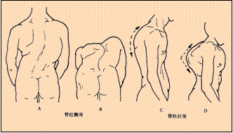 鸡胸怎么办(鸡胸怎么办最有效的方法)