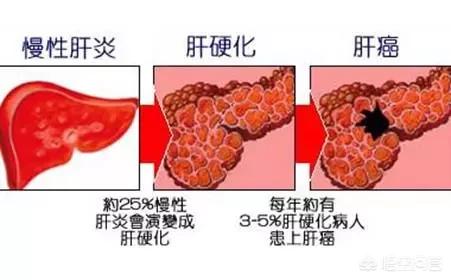 头条问答 肝硬化晚期抽了腹水人会怎么样 生如夏花心似冬雪的回答 0赞