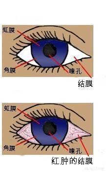 白眼球发蓝有血丝:白眼珠无缘无故出血，无痛感无任何不适，是什么原因？