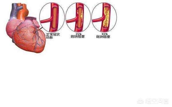 冠心病的拼音，冠心病和心绞痛的区别是什么？