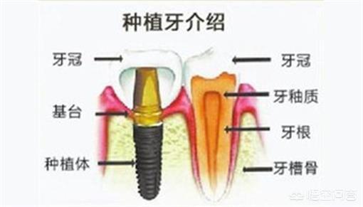 镶牙的种类(镶牙的种类和价格)