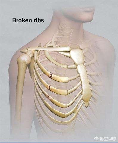 头条问答 左上侧第一根肋骨骨折至今半年 现在还是隐隐作痛是怎么回事 1个回答