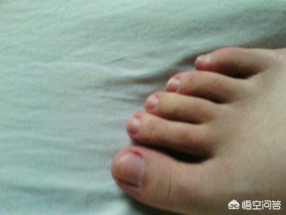 头条问答 小脚趾没有指甲盖 是怎么回事 5个回答