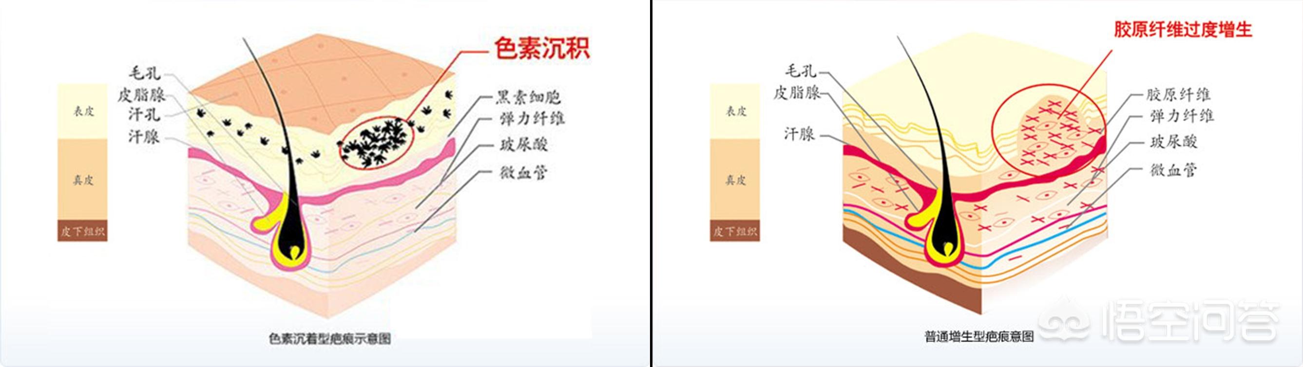 头条问答 什么是疤痕体质 大树爸爸的回答 0赞