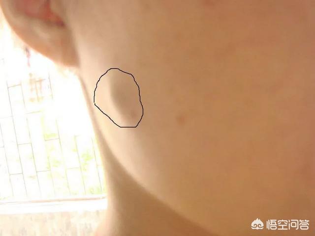 头条问答 怎么区别粉瘤和瘢痕 7个回答