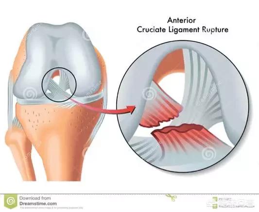 前十字韧带断裂 症状:前交叉韧带撕裂，是什么级别的伤病，恢复需要多久？