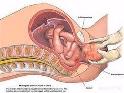 肩难产:肩难产腹围标准 新生儿臂从神经损伤能治好吗？