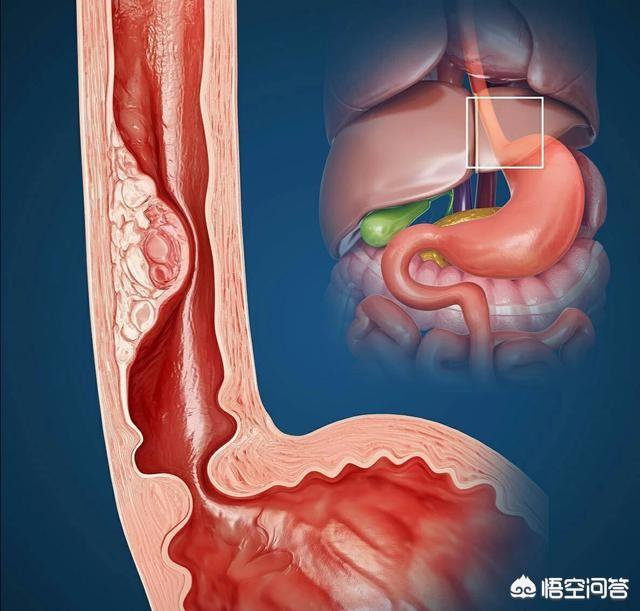 头条问答 胃食道逆流会导致食道癌吗 6个回答