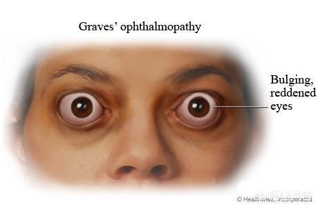 甲亢患者如何做好日常保养