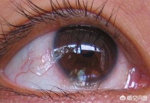 美瞳戴久了对眼睛有什么伤害，长时间戴美瞳对眼睛有什么影响
