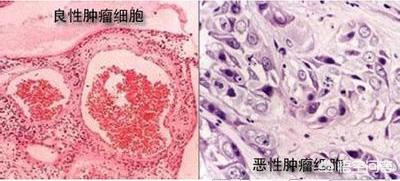 头条问答 肿瘤是癌症吗 118个回答