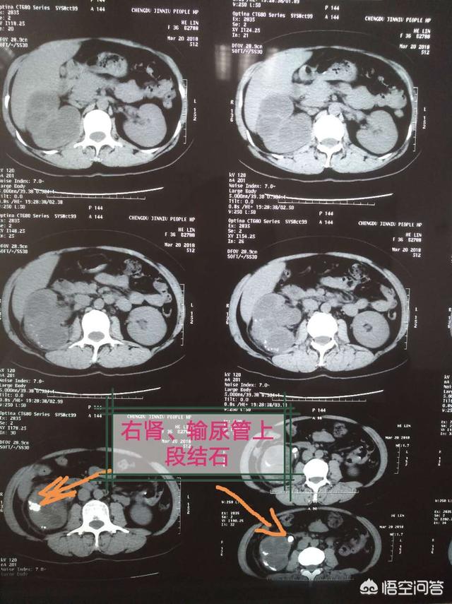 尿结石最佳治疗方法碎石:女性尿结石的最佳治疗方法 得了尿结石应该注意什么呢？