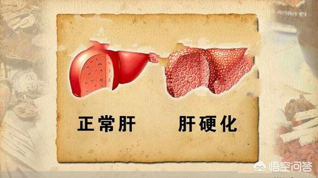 头条问答 - 酒精肝硬化能喝蜂蜜吗?(7个回答)