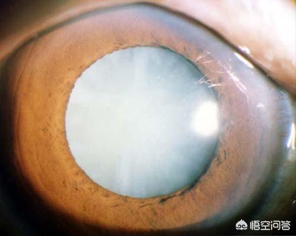 治疗白内障 天天明眼药水好用吗 眼睛之家的回答 头条问答