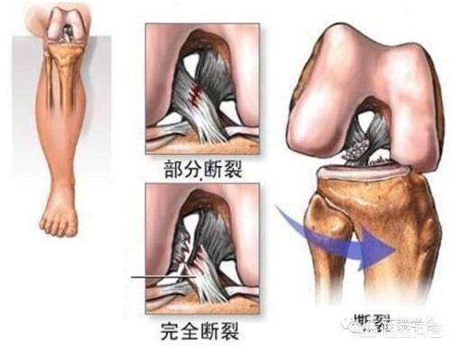 前十字韧带断裂 症状:前交叉韧带撕裂，是什么级别的伤病，恢复需要多久？