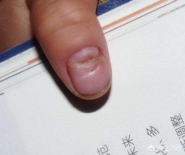 指甲上有横纹：指甲上有横纹凹陷是怎么回事