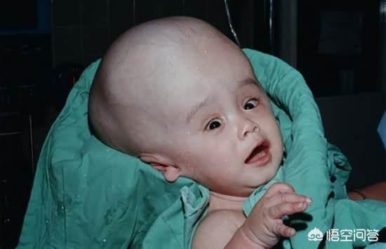小儿轻度脑积水的症状:如何发现婴儿摔伤头部后引起的慢性脑积水？