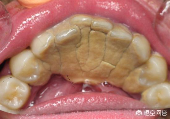 但是我害怕洗牙后会漏风,怎么办?(12个回答)