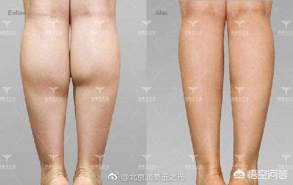 肌肉腿可以抽脂吗:大腿抽脂吸脂是什么体验？