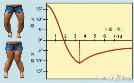 o型腿怎么办(怎么矫正o型腿)