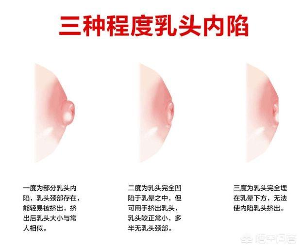 产后哺乳乳腺炎的症状:哺乳期间乳腺炎的症状及处理方法 哺乳期谨防急性乳腺炎，产妇如何预防？