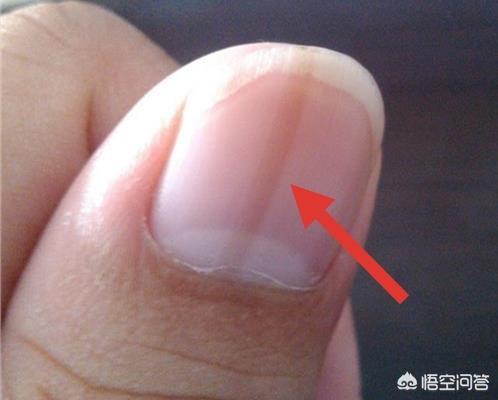 指甲有竖纹是怎么回事;指甲上长竖条是什么原因