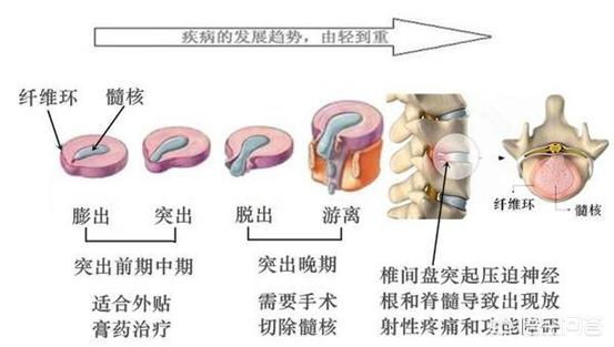 头条问答 椎间盘明明不突出 为什么还会腰痛 脊柱特工的回答 0赞