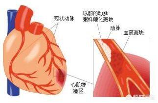 抢救运动:抢救运动死了多少人 做了支架手术可以做运动吗？