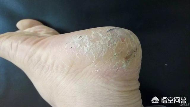 头条问答 脚癣和脚气有什么区别 人体探索者的回答 0赞