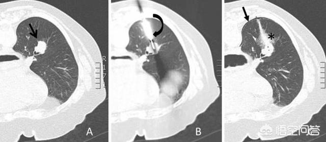 头条问答 是不是做了肺部穿刺就一定是肺肿瘤或者肺癌 14个回答