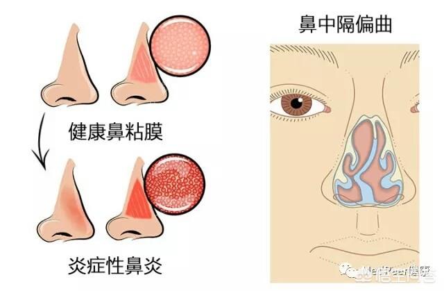 鼻子干怎么办:鼻子经常发干，如何解决(有过敏性鼻炎)？