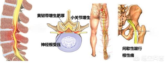 头条问答 得了腰椎管狭窄会出现怎样的症状 科学运动与健康的回答 0赞