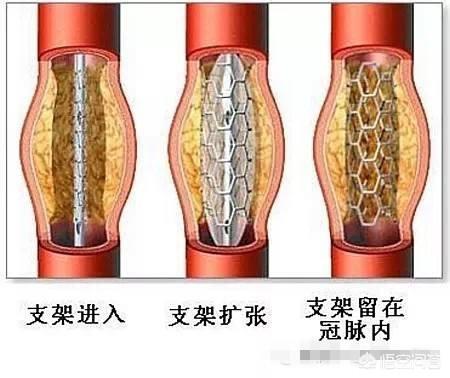 得了冠心病能出去旅游吗？插图29