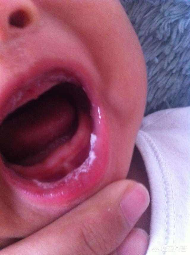 小儿鹅口疮有什么症状，宝宝起了鹅口疮，是什么症状