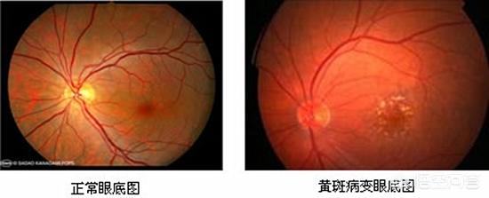 头条问答 眼底有斑应该怎样消除 3个回答