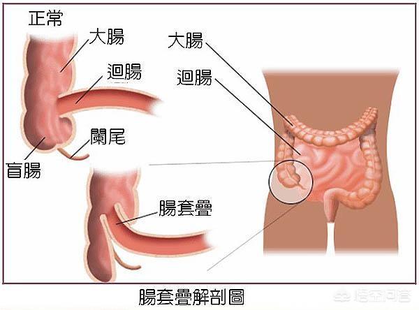 宝宝肠梗塞是怎么引起的:小婴儿肠套叠是什么引起的？