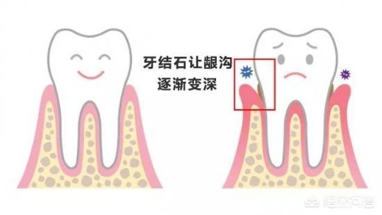 牙结石症状:牙结石症状是什么 牙结石是如何形成的？洗了牙之后要怎么做才能防止再长牙结石？