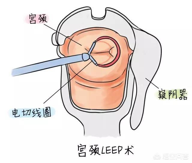 头条问答 - 你好,我做了宫颈锥切手术,手术后要怎样护理才能很快恢复?