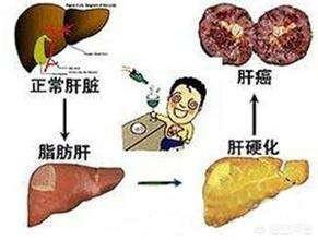 肝硬化患者如何选择优质蛋白？