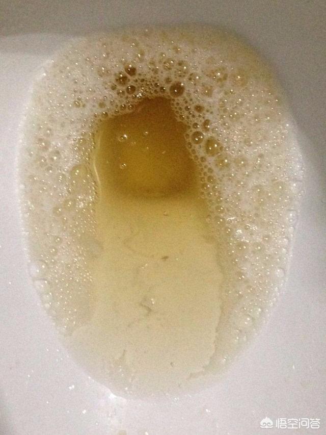 泡沫越多说明蛋白尿越严重吗?(96个回答)