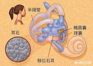 蒙淘克怪兽是怎么回事:耳石症是什么，它有哪些症状？