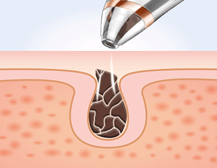 家用美容仪效果如何有用吗