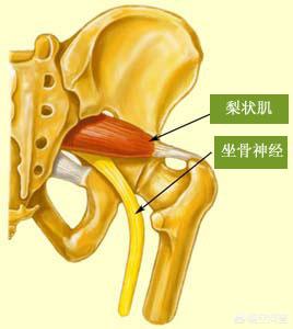 梨状肌综合症都有什么症状