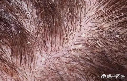 螨虫感染:头上长螨虫危害如何？大过头上长虱子的危害吗？